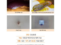 담낭용종수술후기. 처음 ..
