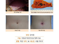 담석증수술후기. 담석증으..