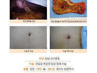 담낭선근종증수술후기. 김..