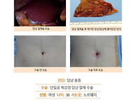 담낭용종수술후기. 빠르게..