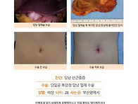 담낭선근종증수술후기. 타..