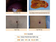 담낭용종수술후기. 수술 ..