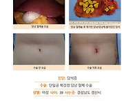 담석증수술후기. 20분도 ..