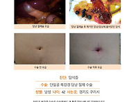 담석증수술후기. 단일공 ..
