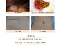 담석증수술후기. 담석증으..