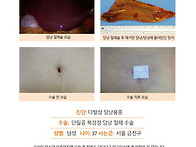 다발성담낭용종수술후기. ..