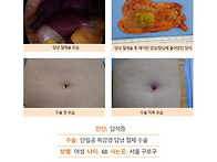 담석증수술후기. 담석증을..