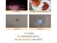 담낭용종수술후기. 1년 전..