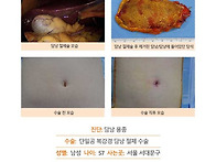 담낭용종수술후기. 정기 ..