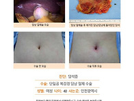 담석증수술후기. 두 달 전..