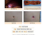 만성담낭염수술후기. 원장..