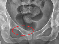 Pubis Fracture의 보존..