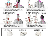 목이 아플 때 근육..