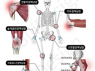 700 전신 점액낭 ..