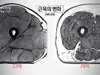 20대와 70대의 허벅지 단..