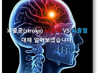 뇌졸중, 뇌출혈 vs 뇌경색