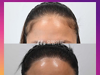 [30대 여자 비어있는 탈모..