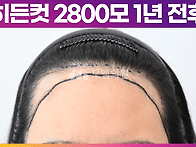 [20대 여자 넓은 M자이마 ..