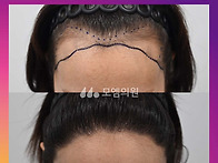 [30대 여자 넓은 M자 헤어..