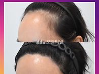[40대 여자 높은 헤어라인..