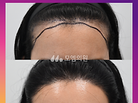 [20대 여자 문신 후 헤어..