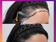 [30대 여자 이마축소후 흉..