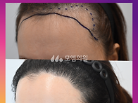 [30대 여자 M자이마 헤어..