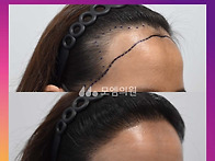 [30대 여자 넓은 M자 헤어..