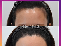 [30대 여자 M자이마 헤어..