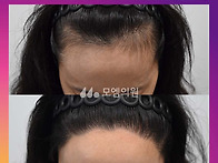 [40대 여자 비대칭 M자이..