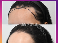 [30대 여자 헤어라인 M자..