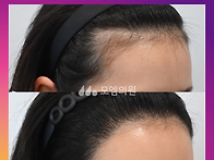 [20대 여자 M자 헤어라인 ..