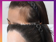 [20대 여자 넓은 M자이마 ..