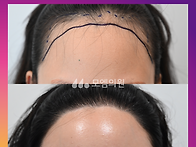 [20대 여자 비대칭 M자 ..