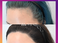 [20대 여자 넓은 헤어라인..