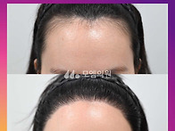 [20대 여자 M자 헤어라인 ..