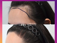[20대 여자 M자 안예쁜 헤..