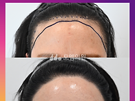 [30대 여자 M자이마 넓은..