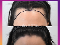 [20대 여자 비대칭 M자 ..