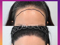 [40대 여자 M자 헤어라인 ..