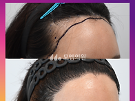 [30대 여자 문신 후 M자..