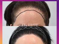 [50대 여자 타병원 헤어라..