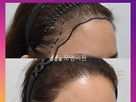 [40대 여자 안 예쁜 M자..