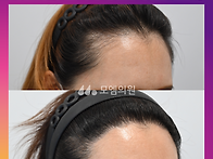 [30대 여자 M자 헤어라인+..