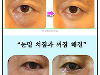 눈밑 지방재배치수술후기 자연스럽게 잘된 ..