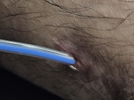 2년전에 수술한 ..