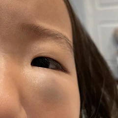 눈 밑 혈관종, 갑자기 부은 날부터 진단까지 썸네일