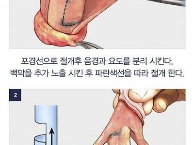 남자 성기 확대 수술 과정