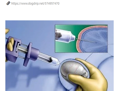 요즘 정액검사시 채취가 힘든 환자를 위한 방법
