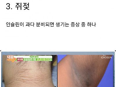 당뇨 걸리면 나타나는 증상들